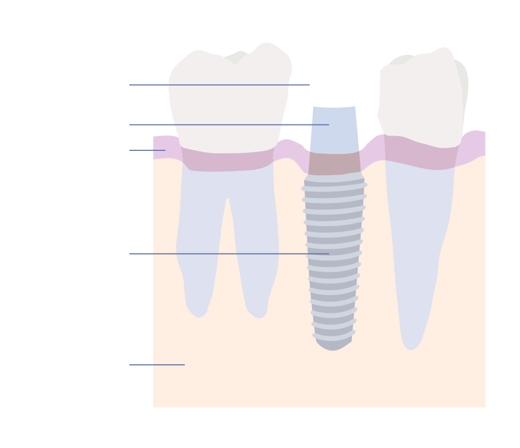 myEndodontist dental implant diagram