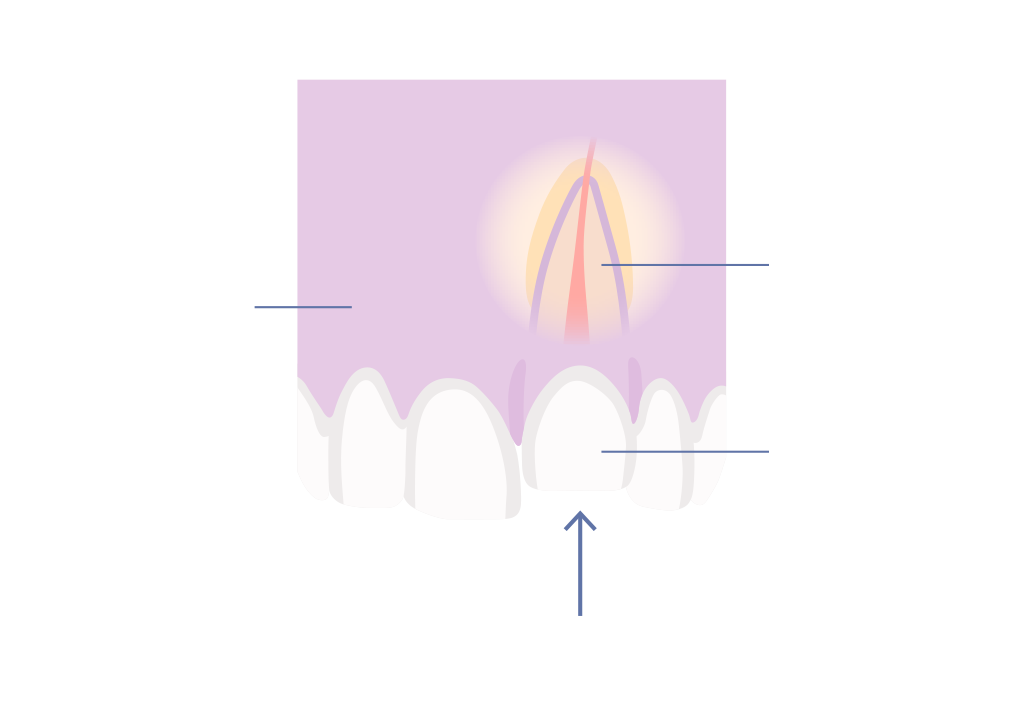 Dental trauma – dislodged tooth inclusion diagram
