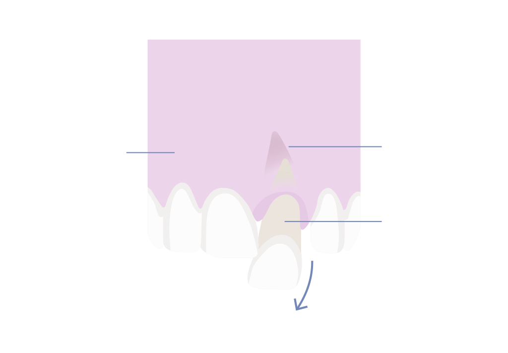 Dental trauma dislodged tooth luxation