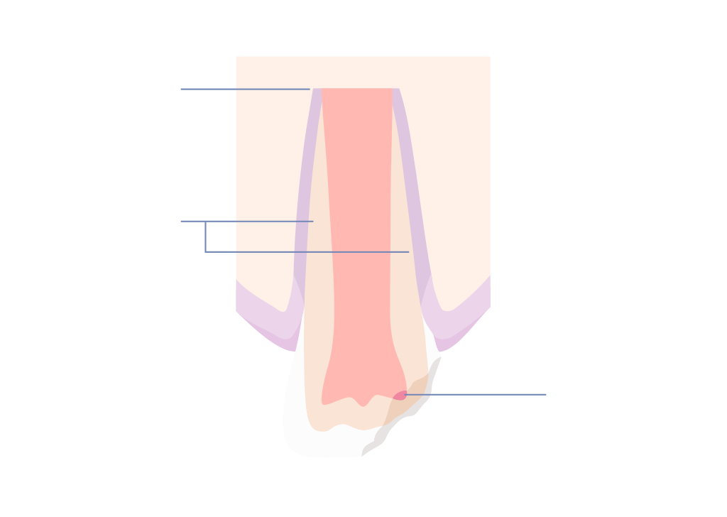 Dental trauma showing a chipped crown in a childs tooth