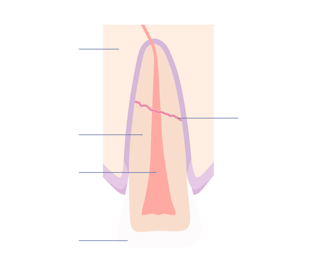 Dental trauma showing a fractured root
