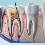 Root Canal Treatment in North Lakes