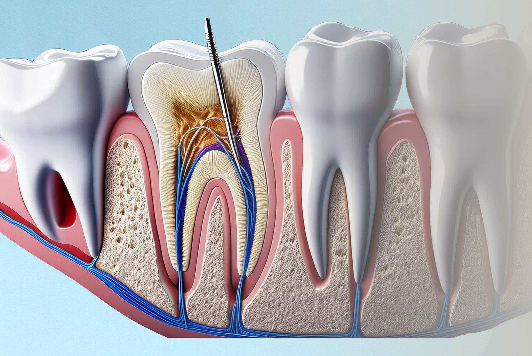 Root Canal Treatment in North Lakes